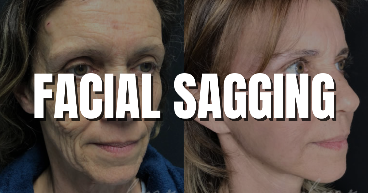 facial sagging