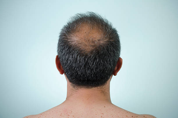 say goodbye to baldness